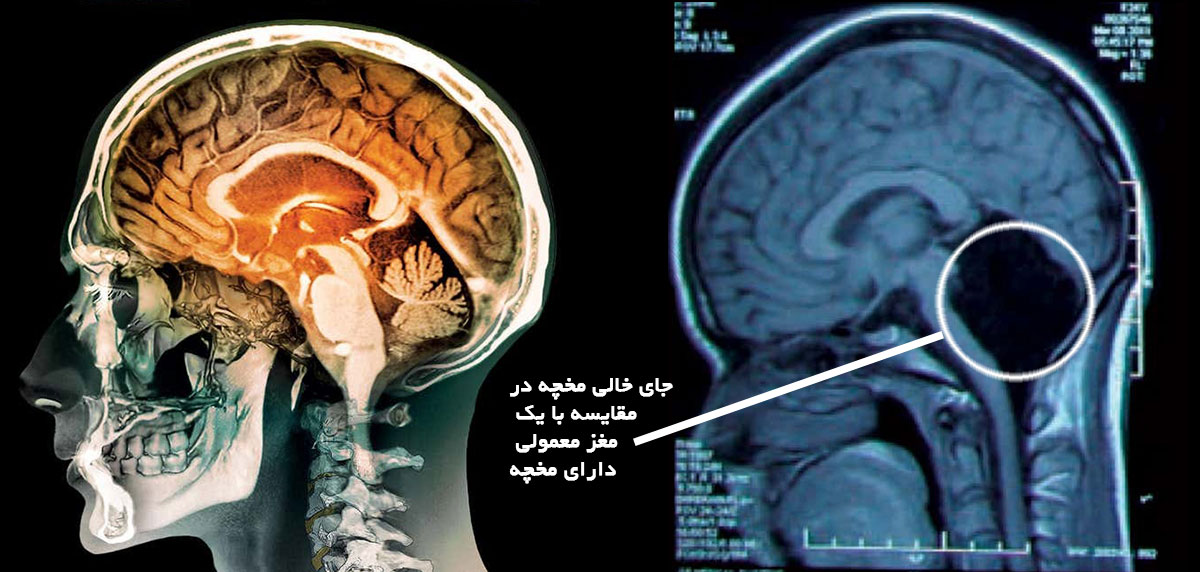 محل قرارگیری مخچه مغز انسان