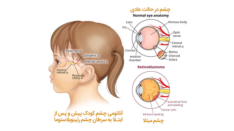 سرطان چشم کودکان رتینوبلاستوما چیست؟