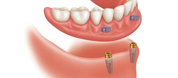 مراحل ایمپلنت دندان مصنوعی ثابت