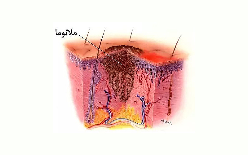 ملانوما سرطان پوست چیست؟